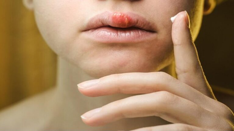 Diese natürlichen Mittel helfen schneller gegen Lippenherpes als jede Medizin…